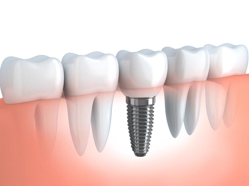 Dental Implants Dearborn, MI 